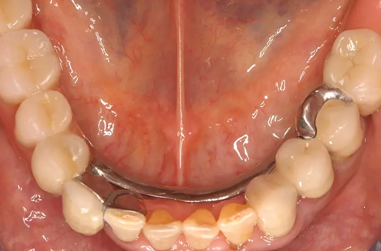 Abb. 4: Definitiv eingegliederte Geschiebearbeit nach Reparatur mittels
Adhäsivattachment 42 (Okklusalansicht).