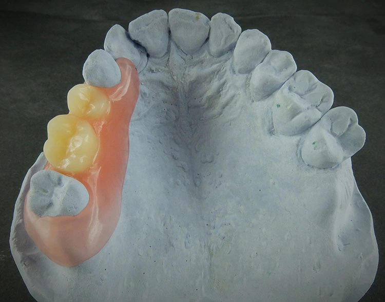 Abb. 4: Fertiggestelltes Provisorium nach dem Bonden und Einkleben der Zähne.