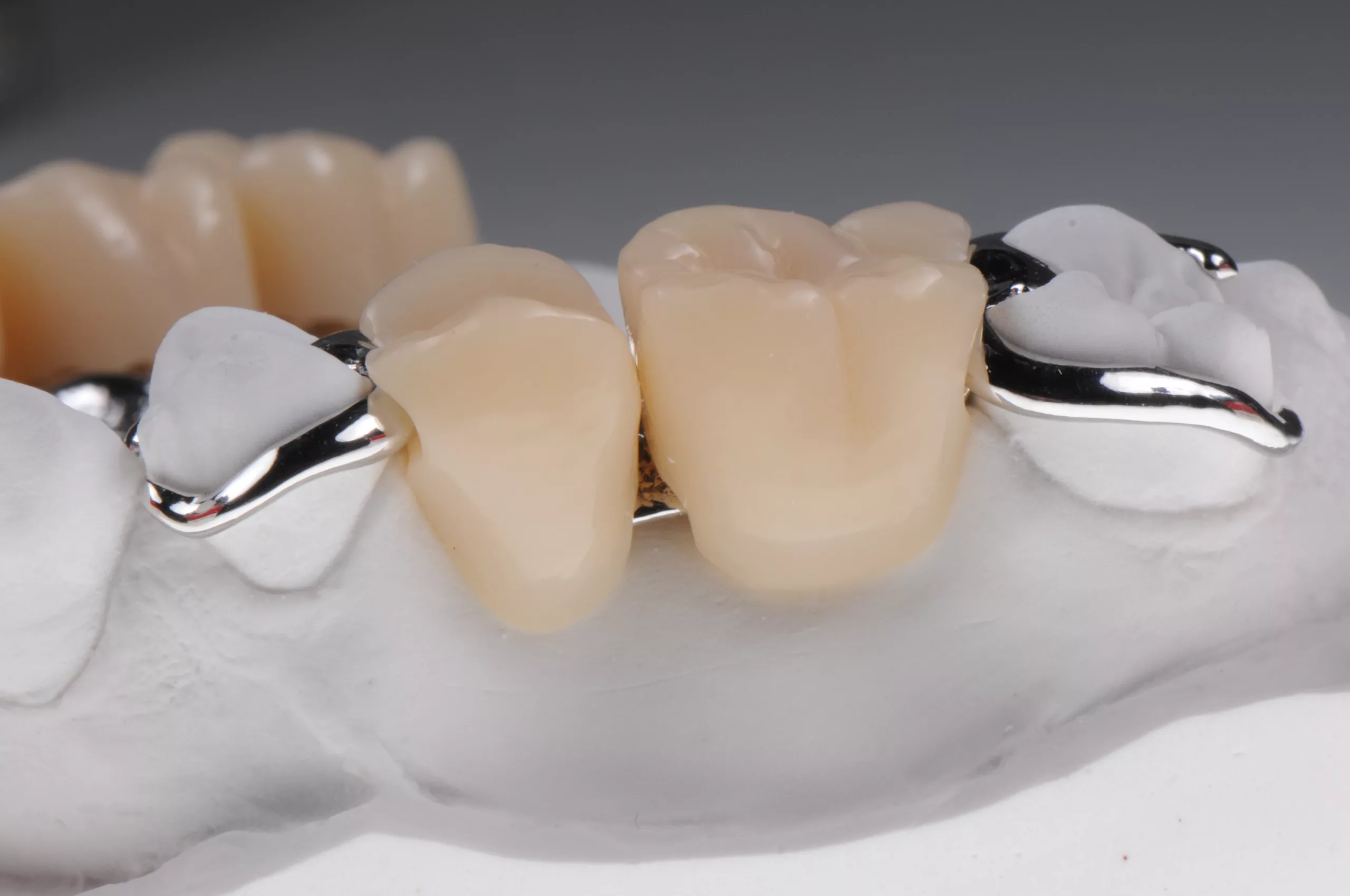 Abb. 4: 3D-Druck der Ersatzzähne aus VarseoSmile Teeth-Material (BEGO).