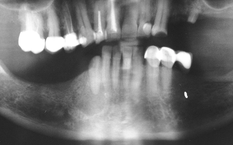 Abb. 4: Extraorale Fistel bei Diabetes: klinischer und röntgenologischer Befund, ausgehend vom tief zerstörten Zahn 43.