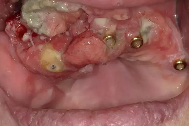 Plattenepithelkarzinom des Oberkiefers.