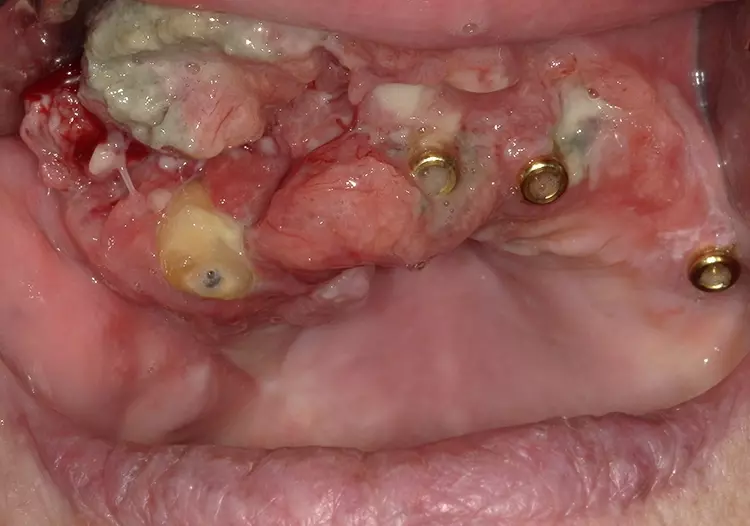 Plattenepithelkarzinom des Oberkiefers.