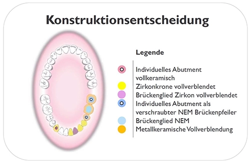 Abb. 3: Die prothetische Planung für den Unterkiefer.