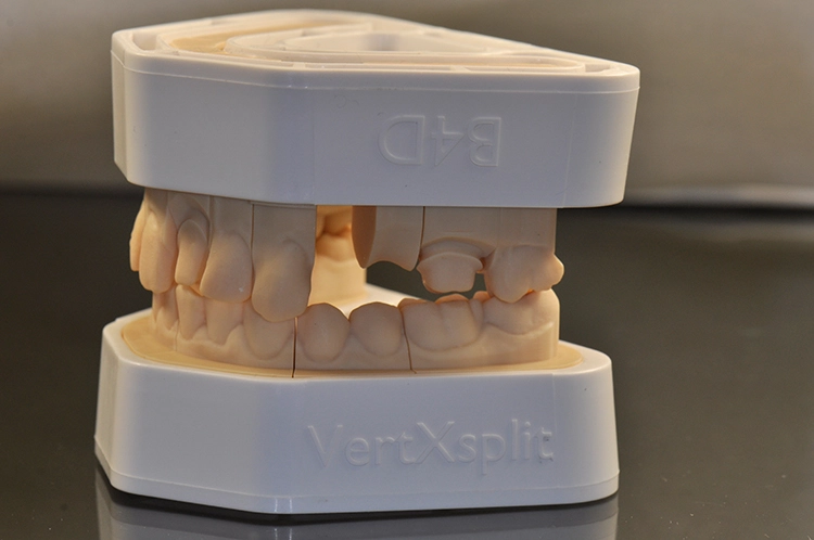 Abb. 4: VertXsplit Sockel OK+UK.
