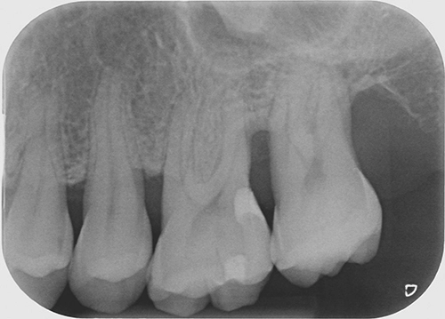 Abb. 4: Zahnfilm des 2. Quadranten nach Abschluss der Füllungstherapie, deutlich sichtbar das im zervikalen Anteil verwendete Bulk Fill-Flowable (SDR Flow +, Dentsply Sirona Deutschland GmbH, Bensheim), das mit einem Hybridkomposit (Estelite Sigma Quick, Tokuyama Dental Deutschland, Altenberge) abgedeckt wurde.