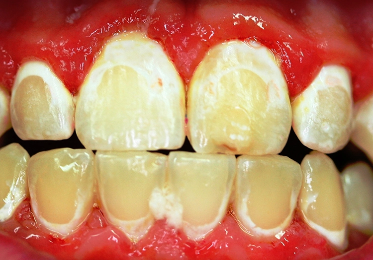 Abb. 4: Aktive kariöse (Initial)Läsionen an allen hier abgebildeten Zähnen bei einem Patienten in KFO-Therapie nach Entfernung der festsitzenden Multiband-Apparatur. Zudem ist eine deutliche Gingivitis sichtbar.