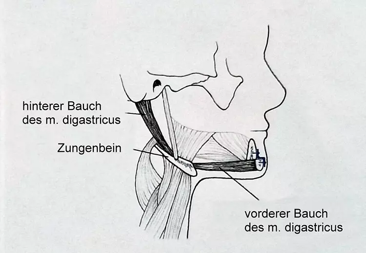 Abb. 4: Anhebung des Hyoids und Straffung des Mundbodens durch Vorverlagerung des Kinnsegmentes; aus Lindorf: Die Kinnplastik zur Verbesserung des
Gesichtsprofils [9].
b: post Op.