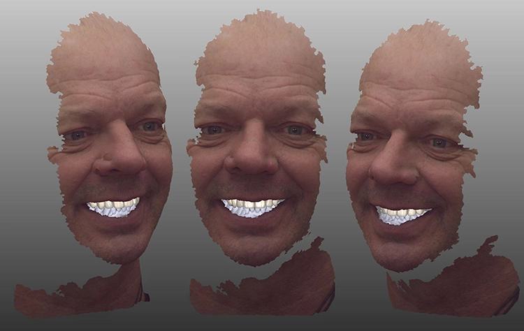 Abb. 4: Die mit dem Gesichtsscan gematchte Ausgangssituation diente als Startpunkt für die Konstruktion der verblockten Kronen.