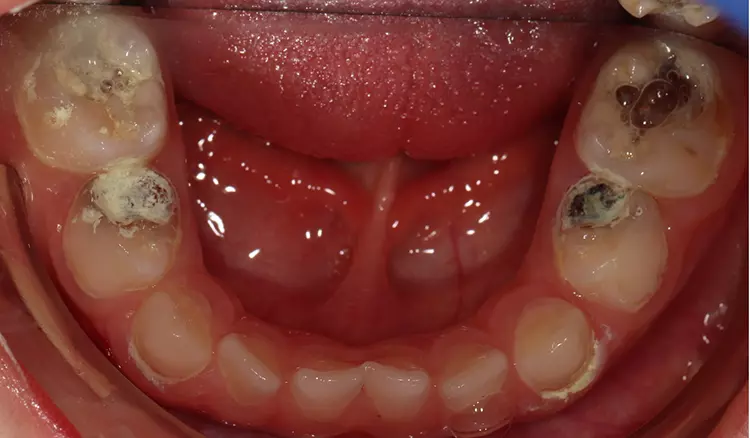 Abb. 4a-c: Zähne des 4-jährigen Jungen beim 2. Besuch während der Applikation der 2. Komponente (grüne Kapsel mit Kaliumiodid) von Riva Star®. (c) im Unterkiefer.