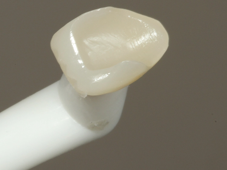 Abb. 19: Die äquivalent zu Zahn 11 vorbehandelte Teilkrone für Zahn 21.