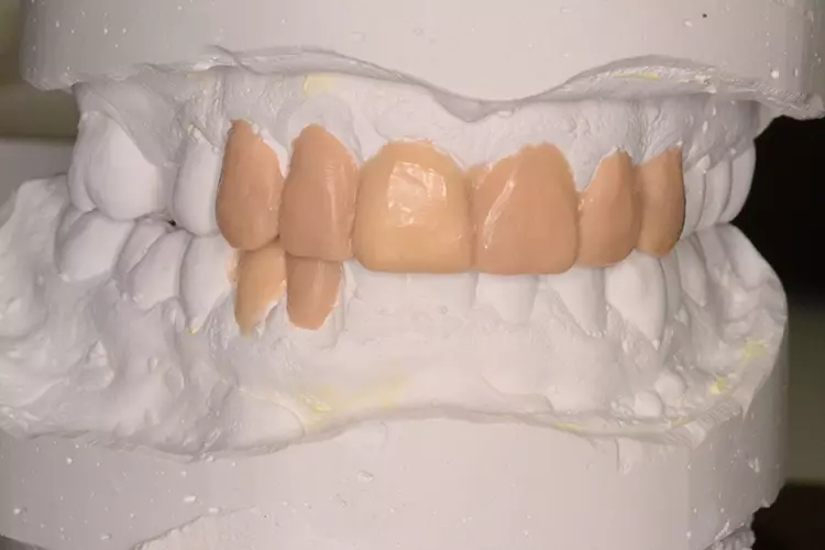 Abb. 4b: Wax-up.