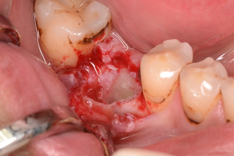 Abb. 4c: Implantatbohrung.