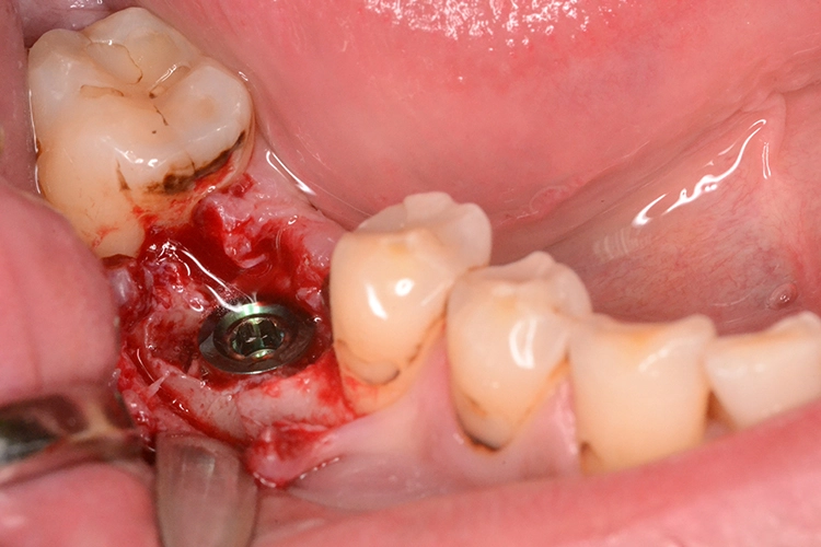 Abb. 4d: Implantation.
