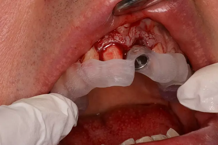 Abb. 4d: Schablonennavigierte Implantation.