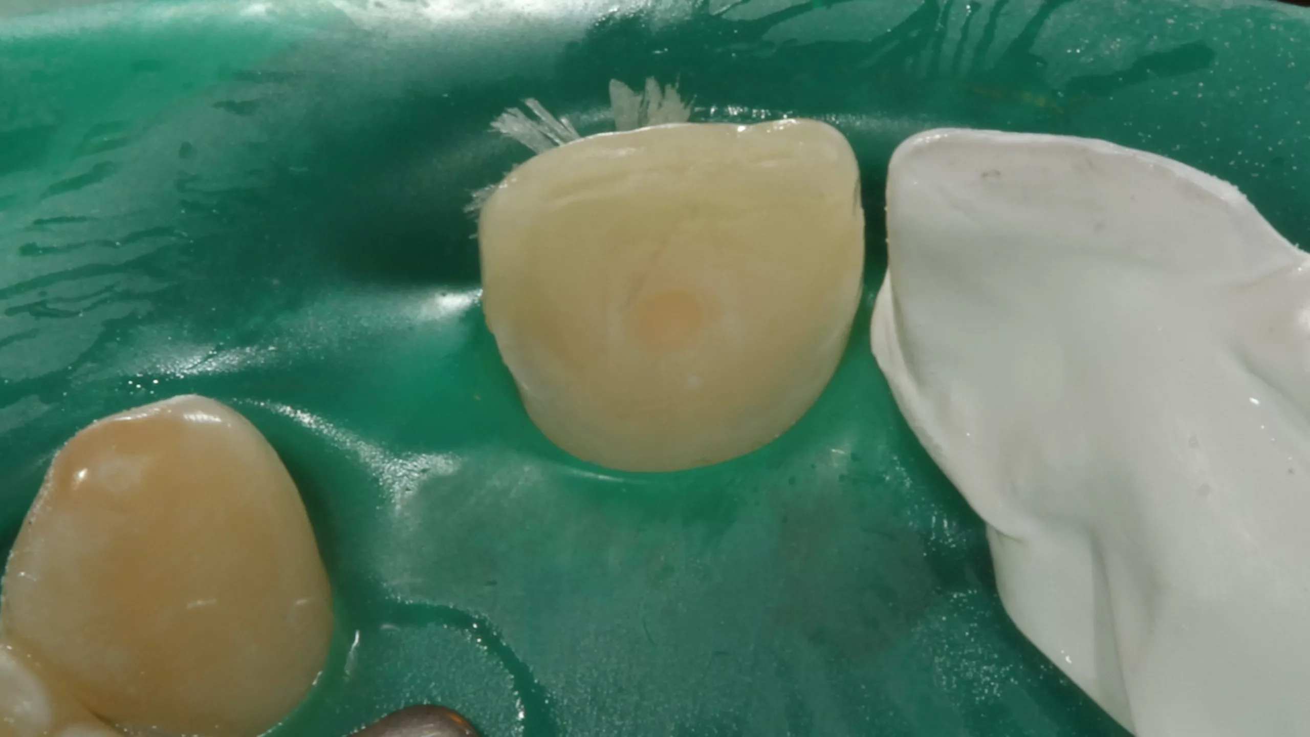 Abb. 49: Die komplett zur Verklebung vorbehandelte Fläche des Zahnes.