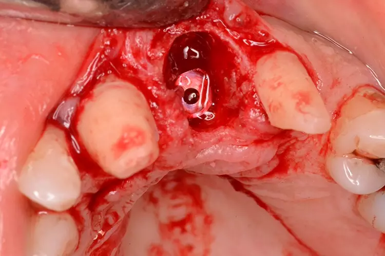 Abb. 4e: Implantat 21.