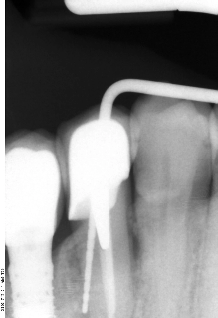 Abb. 1: Radiologische Diagnostik des endodontisch vorbehandelten Zahns 15.