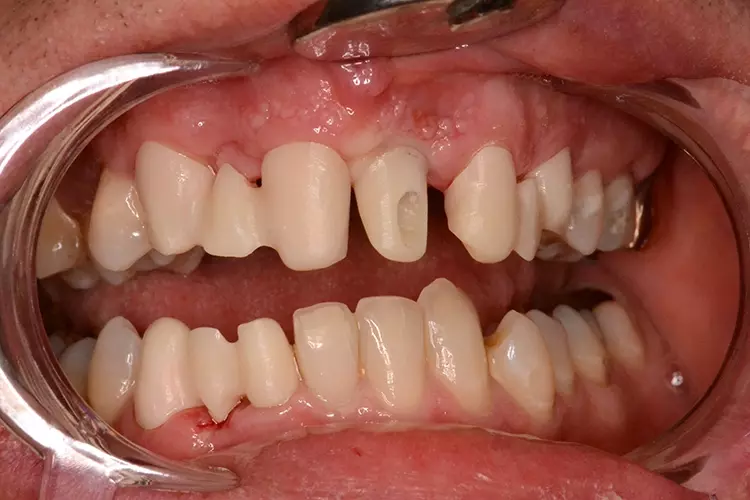Abb. 4g: Zirkonabutment.