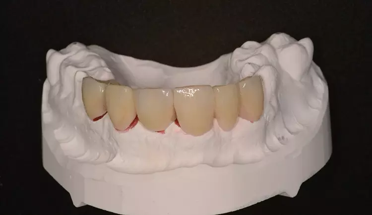 Abb. 4h: Restauration Oberkiefer.