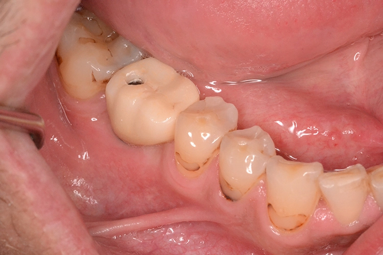 Abb. 4j: Prothetische Versorgung; Dentallabor Schaeffer ZTM Michael Franke.