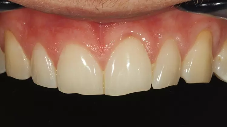 Abb. 50: En face-Aufnahme des Patienten mit
Abrasions- und Attritionsspuren bei der Laterotrusion
und der Protrusion.