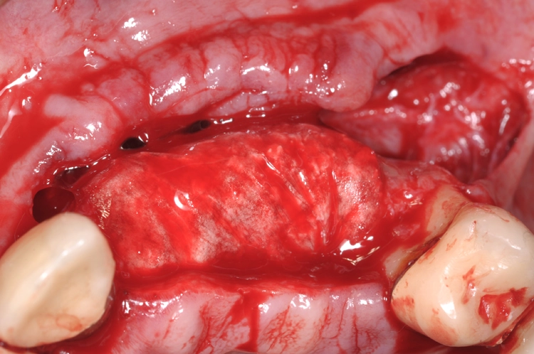 Abb. 12: Stabilisierung des Augmentats mit Hilfe einer Kollagenmembran.