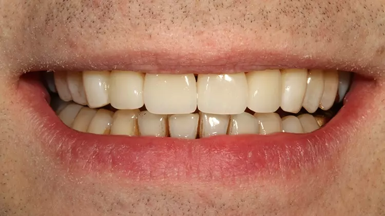 Abb. 53: Lippenbild des sehr zufriedenen Patienten. Die Versorgung ohne die
kieferorthopädische Vorbehandlung wäre so nicht möglich gewesen.