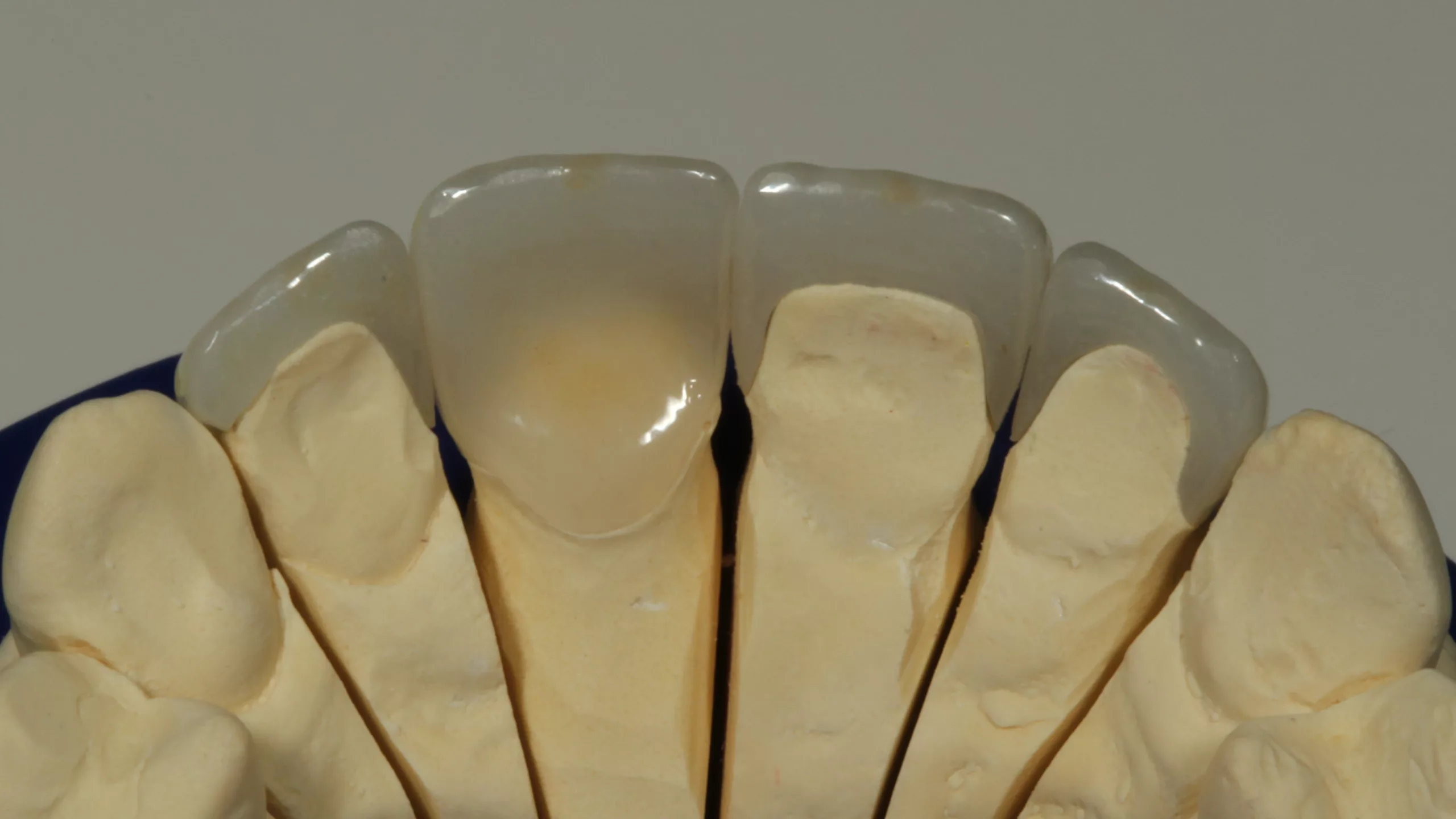 Abb. 32: Ansicht der Laborarbeit von inzisal: Kronenversorgung auf Zahn 11, Teilkronen auf den Zähnen 12, 21 und 22.