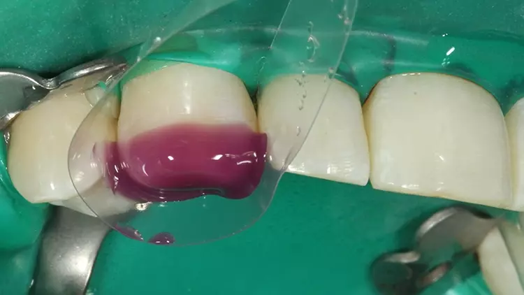Abb. 55: Die Phosphorsäurekonditionierung der
Klebefläche an Zahn 13 mit dem Optibond Gel
Etchant.
