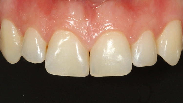 Abb. 42: Endergebnis der Versorgung in En-face-Ansicht.