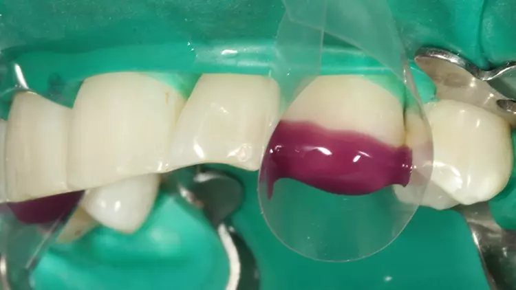 Abb. 56: Die Phosphorsäurekonditionierung der
Klebefläche an Zahn 23 mit dem Optibond Gel
Etchant.