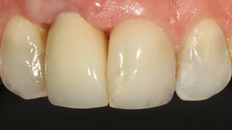 Abb. 13: Kontrolle nach einem Jahr. Es zeigen sich gesunde gingivale Verhältnisse und ein Stopp der Rezession.