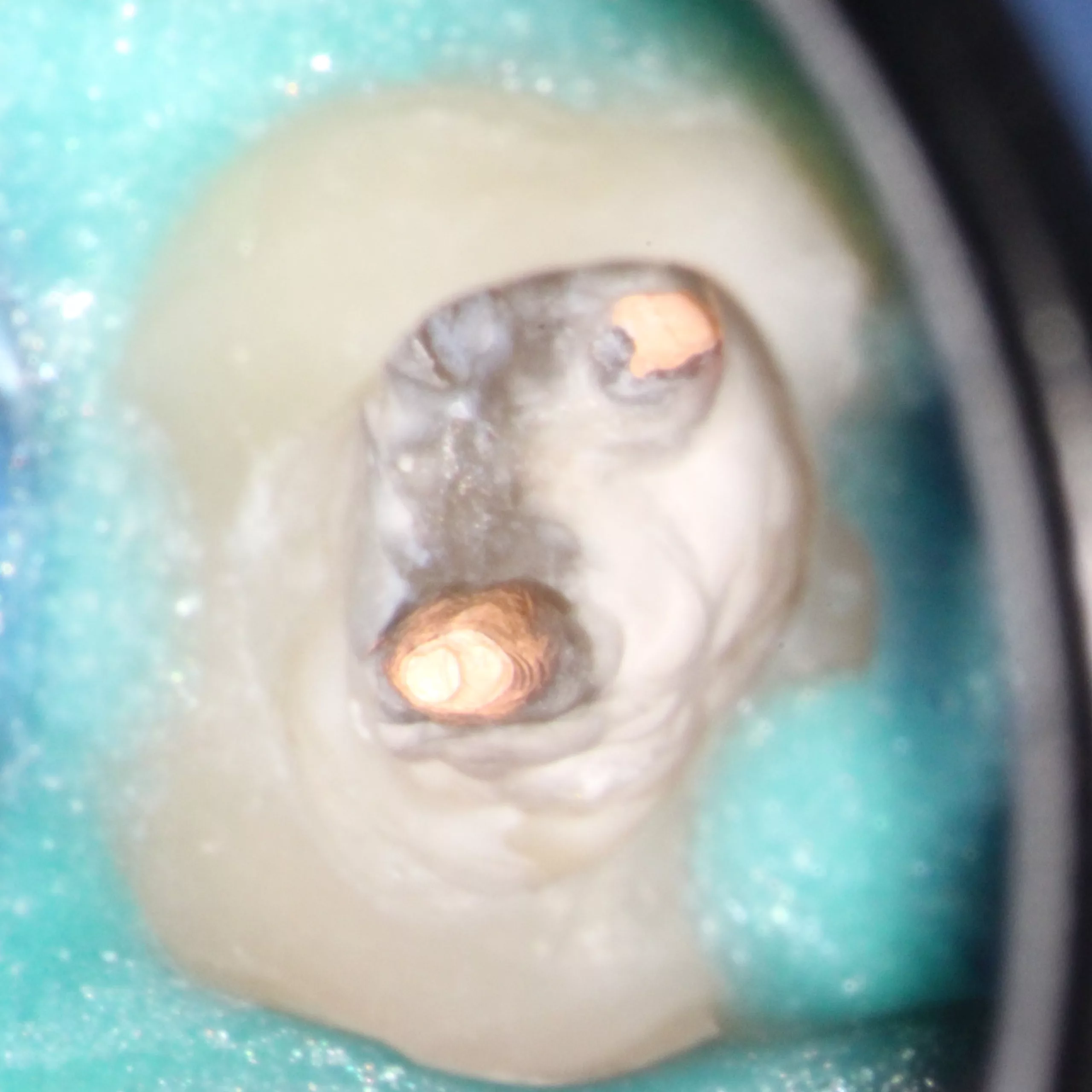 Abb. 55: Klinische Situation nach der vertikalen Kondensation des Wurzelfüllmaterials.