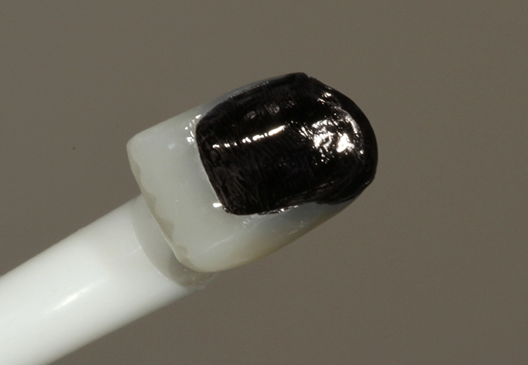 Abb. 12: Teilkrone für den Zahn 11 mit Clip in einem Pinselhalter als Handgriff fixiert und mit einem Permanentmarker farblich markiert – unmittelbar vor dem Nachstrahlen mit CoJet.