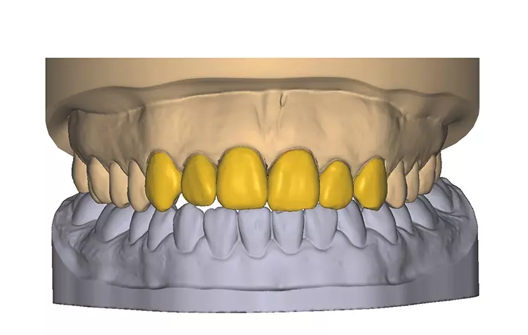 Abb. 5: CAD-Design der ultradünnen Veneers.