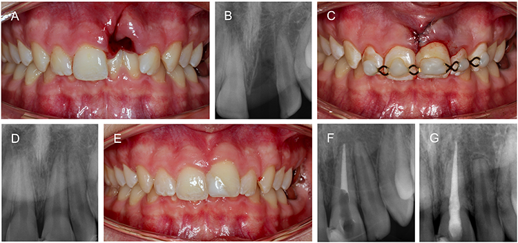 Abb. 5: Avulsion des Zahnes 21. (A) Hart- und Weichgewebsverletzung des Alveolarfortsatzes. (B) Kontrollröntgenaufnahme vor der Replantation. (C) Replantation,
Schienung und Naht. (D) Postoperative Röntgenkontrolle. (E) Klinischer Status nach 4 Wochen. (F und G) Röntgenkontrolle nach 4 Jahren zeigt resorptive Prozesse
an den Zähnen 21 und 22.