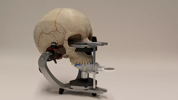 Der Schädel des Patienten wird durch mathematische Algorithmen an die Position des Oberkiefermodells im Artikulator angepasst.