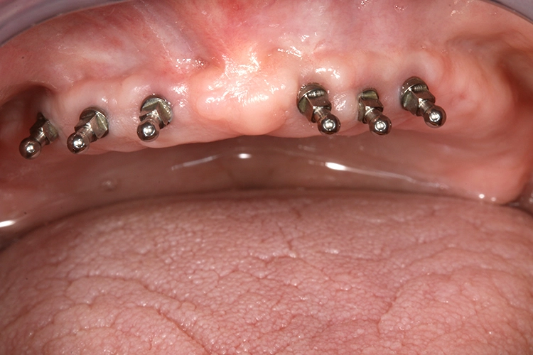 Abb. 5: 6 OK-MDI-Implantate.