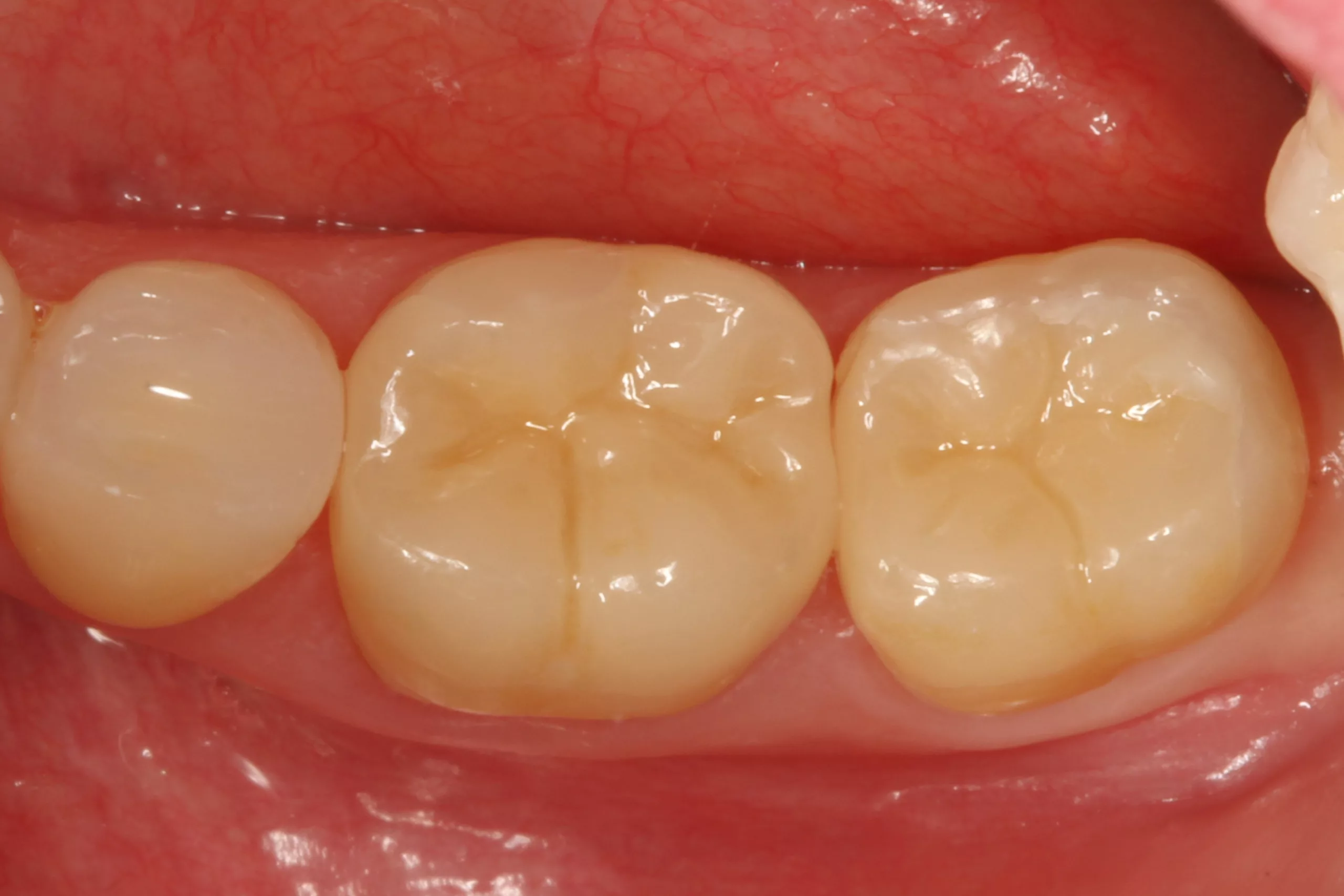 Abb. 5: Das klinische Endergebnis bei einer Kontrolle nach 2 Monaten: Die beiden Lithiumdisilikat-Teilkronen fügen sich ästhetisch harmonisch in die umgebende Zahnhartsubstanz ein.