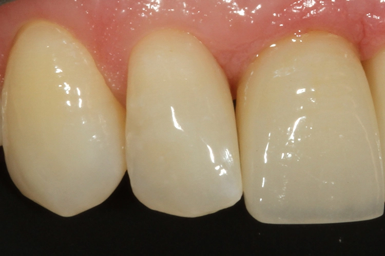 Abb. 5: Kontrolle nach 4 Wochen: Es zeigt sich eine perfekte Farbadaptation und eine klinisch reizlose Gingiva.