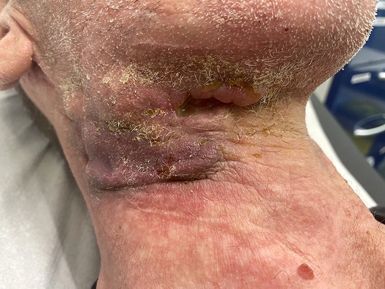 Abb. 5: Submandibulärer Abszess bei Infektion mit atypischen Mykobakterien.