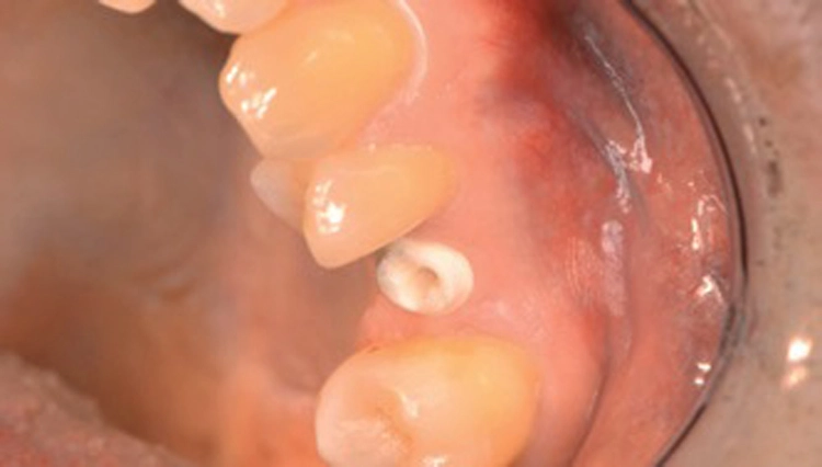 Abb. 5-7: Das Patent™-Zirkon-Implantat wird – wie bei einer Zahnpräparation – mit einem hochpräzisen Polyether- oder Silikonmaterial mit Konfektionslöffel bzw. einem Intraoral-Scanner abgeformt. Es bedarf keines Transferpfostens, keiner Verschraubung, keinem Kontroll-Röntgenbild oder Verschraubung mit „offener Abformung“.