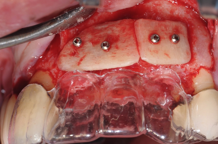 Abb. 5: Frontale Ansicht der allogenen Kortikalisplatten in situ.