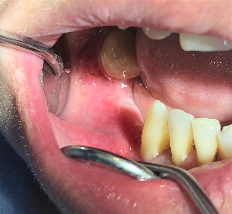 Abb. 5: Situation vor Re-Entry mit klinisch voluminöser Implantatregion und reizfreien Schleimhautverhältnissen.