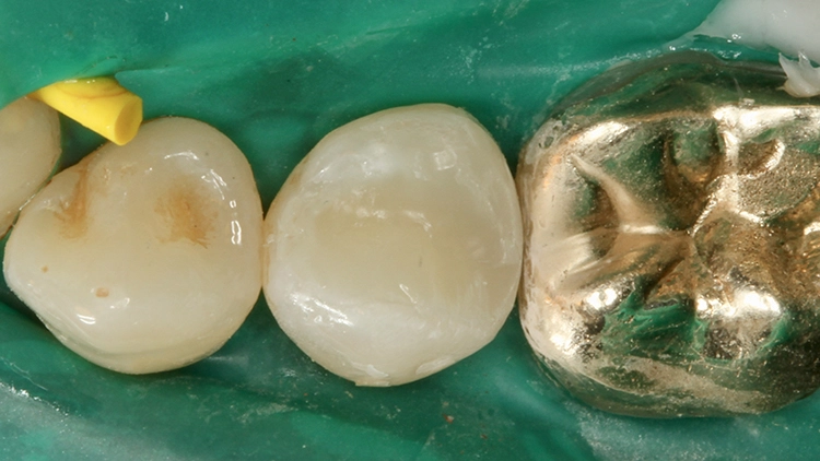 Abb. 5: In mehreren Inkrementen in maximalen Schichtstärken von 2 mm eingebrachtes Füllungsmaterial (Venus Diamond One, Kulzer) unmittelbar nach der Polymerisation und der Ausarbeitung der approximalen Flanken.
