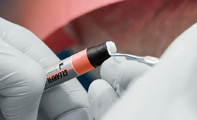 Abb. 5: Die Kavitäten werden mit CLEARFIL MAJESTY ES-2 Universal gefüllt.