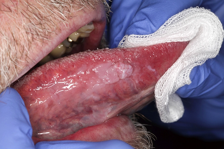 PECA typische Lokalisation: Alle Schleimhautbereiche können betroffen sein, jedoch finden sich PECA meist an Mundboden und Zunge. Hier zeigt es sich typisch anhand einer Leukoplakie und einem zentralen hyperplastischen Ulkus mit peripherem Randwall [1].