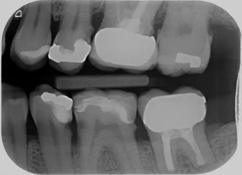 Abb. 5: Bissflügelaufnahme vom 2./3. Quadranten einer 50-järigen Patientin mit Wurzelkaries 35 distal und 36 mesial. Da es der Wunsch der Patientin war, die vollkeramische Teilkrone an 36 zu erhalten, wurden die Defekte mit Komposit gefüllt.