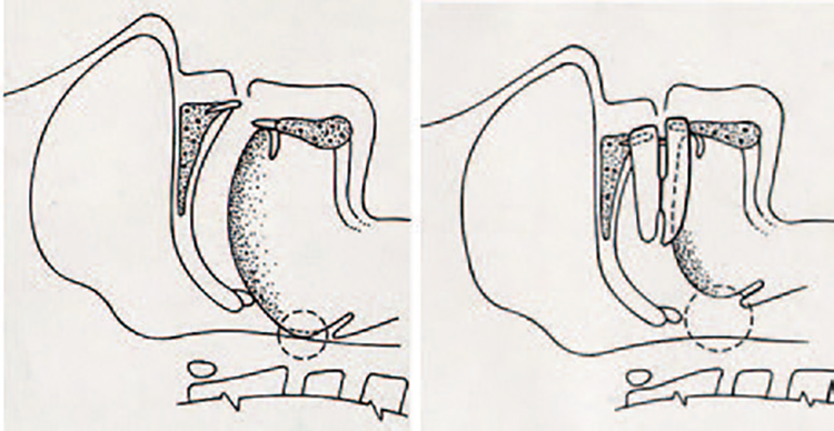 Abb. 5 u. 6: Wirkungsweise einer Unterkieferprotrusionsschiene mit Erweiterung der oberen Atemwege
durch eine Protrusion des Unterkiefers im Schlaf.
