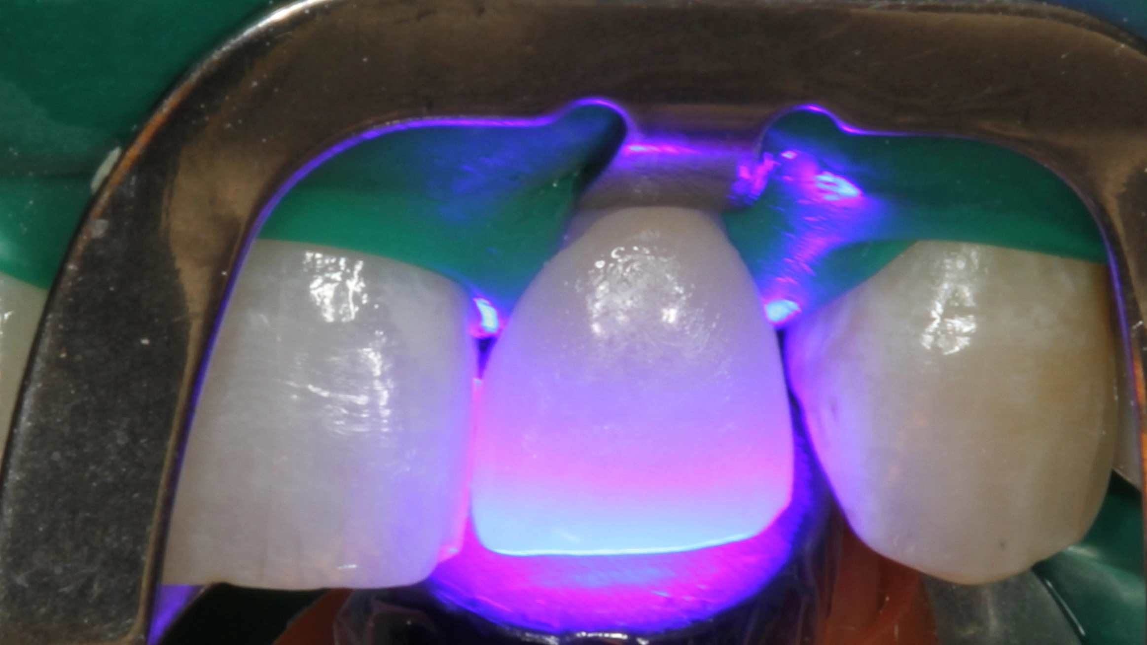 Abb. 25: Polymerisation von Visalys CemCore nach vollständiger Überschussentfernung.